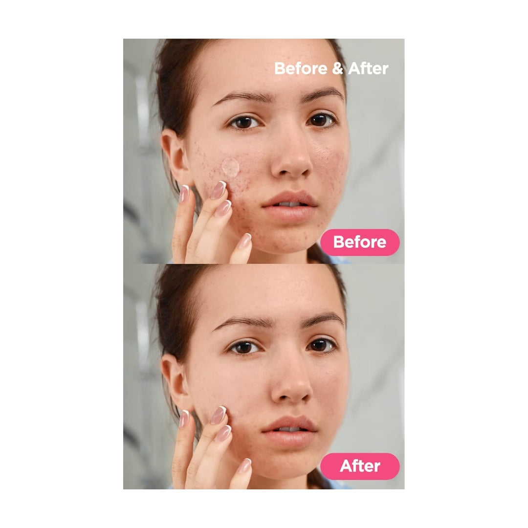 NEOGEN Dermalogy A-Clear Soothing Clear Spot Patch