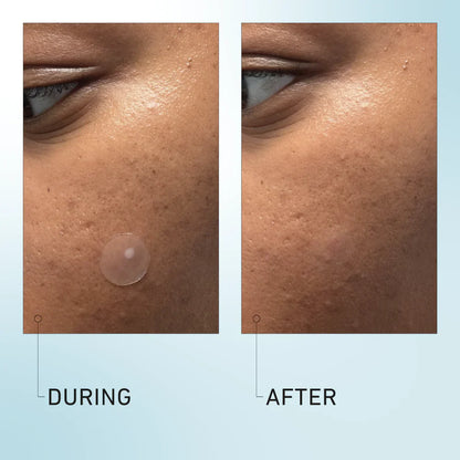 Good Light Luna Pimple Patches